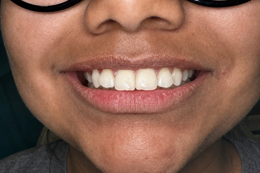 Sonrisa natural después del tratamiento