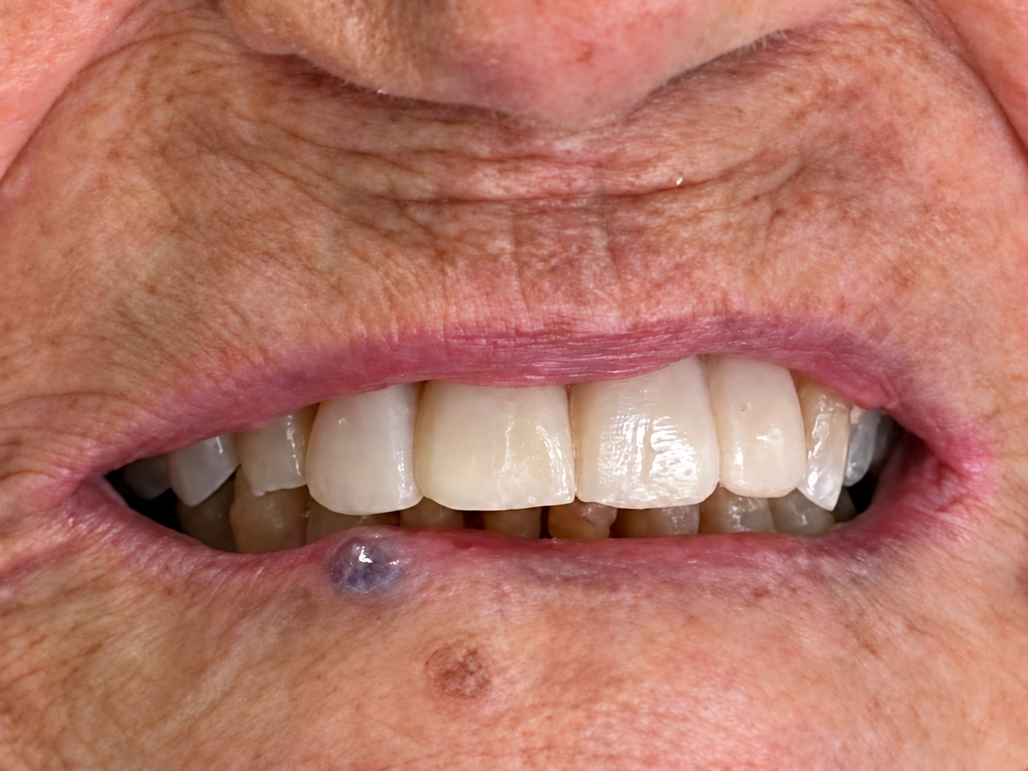 Sonrisa después del tratamiento