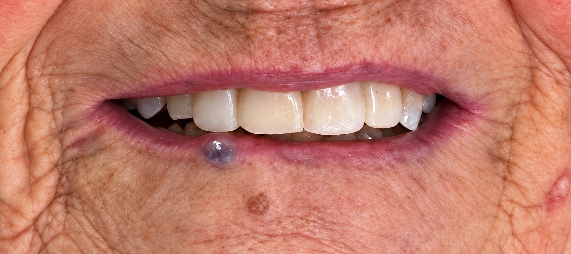 Después · sonrisa con carillas (veneers)