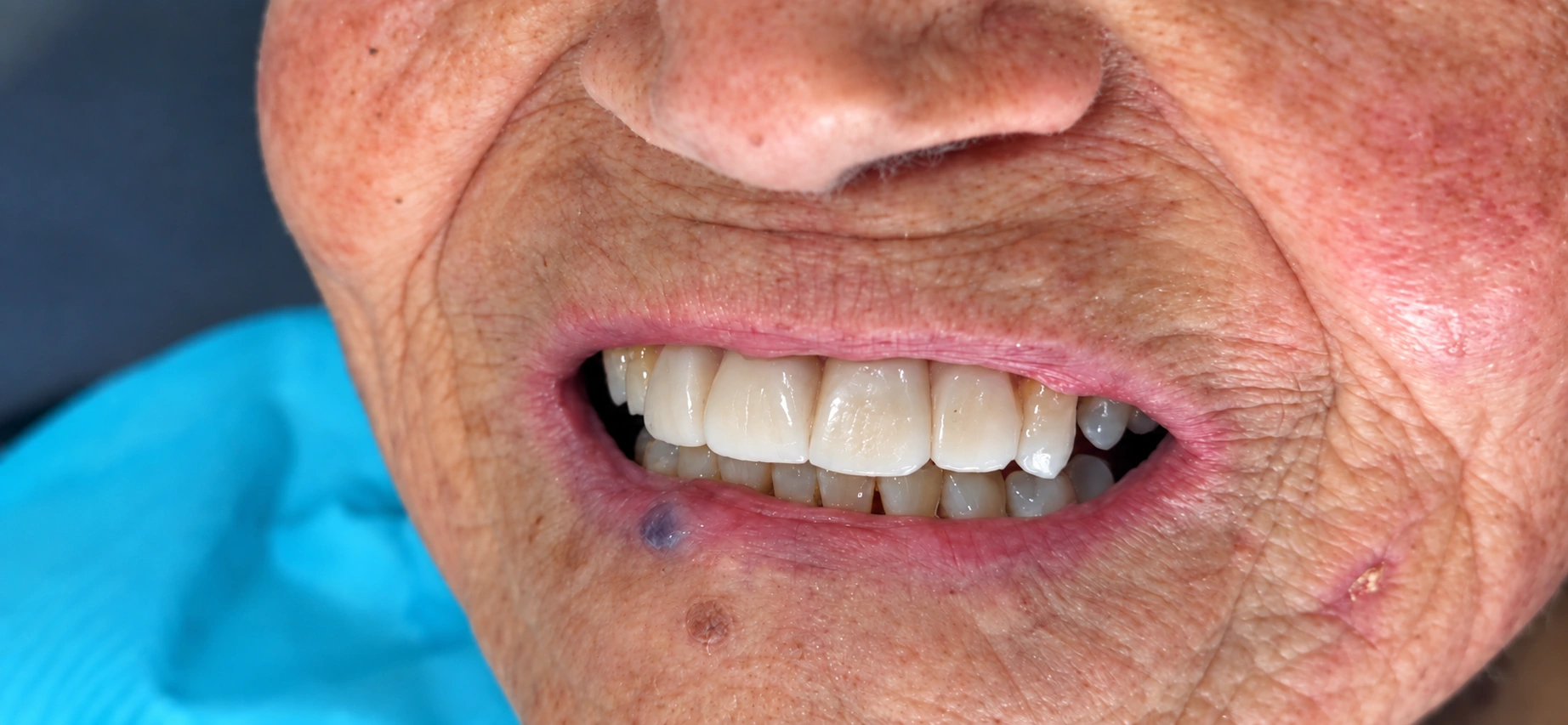 Después · sonrisa con carillas (veneers)