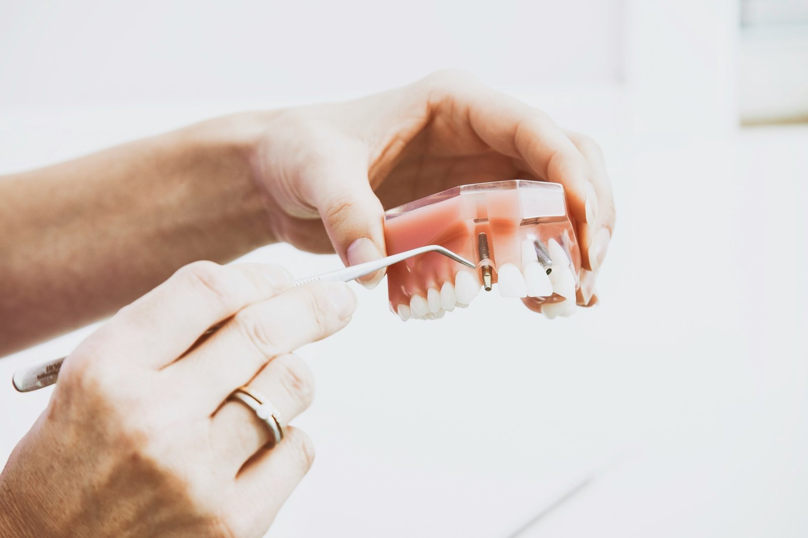 Modelo dental utilizado para explicar un implante