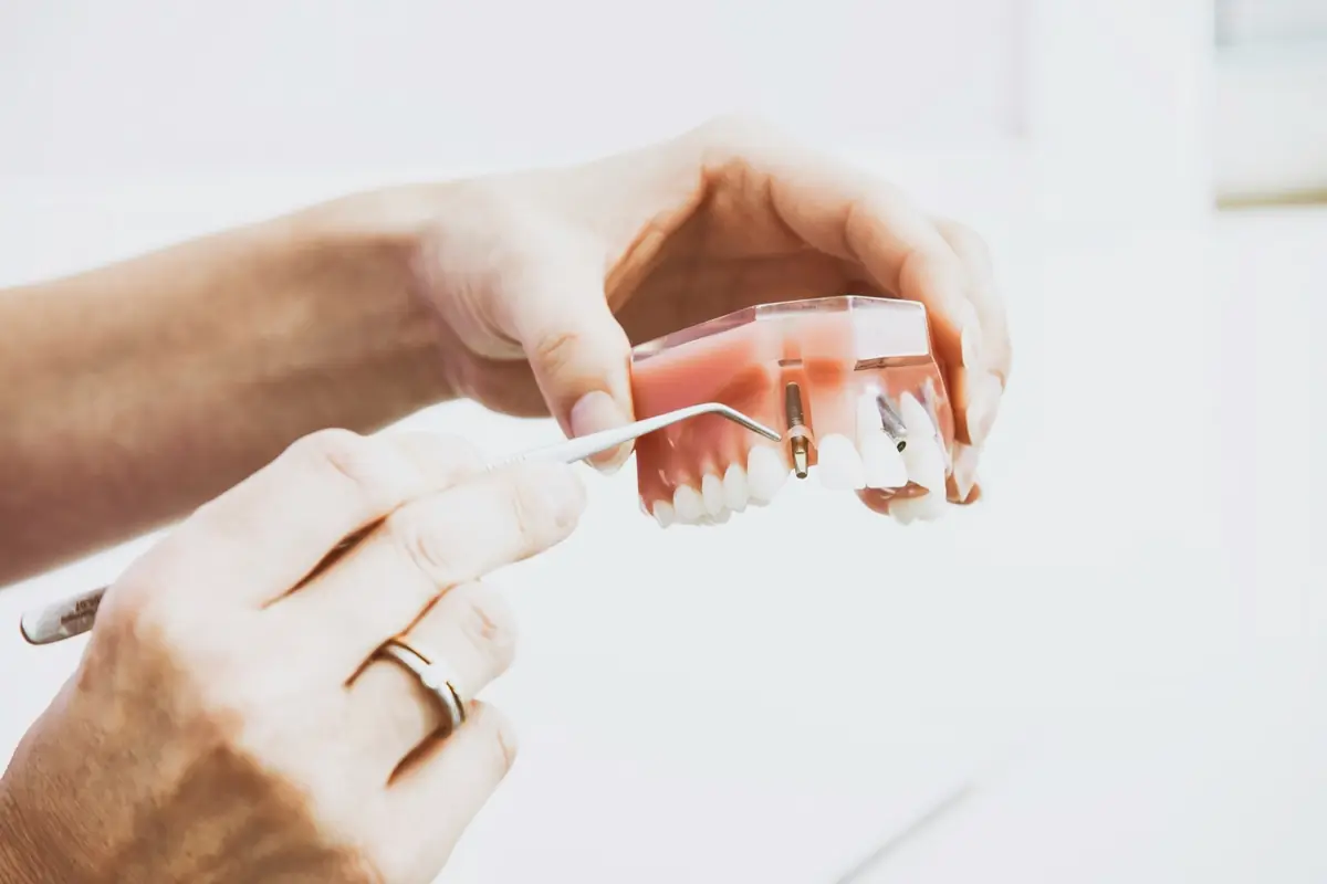 Modelo de implante dental utilizado para explicar el tratamiento